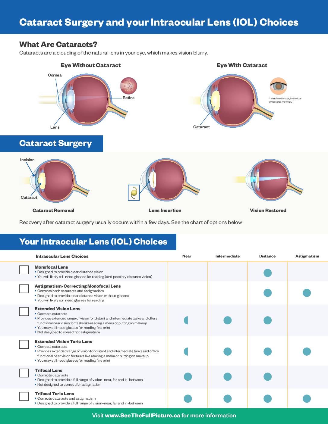Cataracts – Advanced Lenses